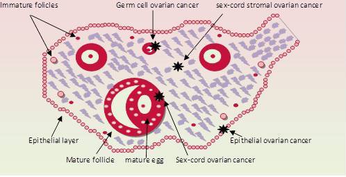 Ovarian cancer epithelial type. Ovarian cancer epithelial types, Ovarian cancer epithelial type