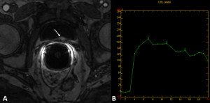 (A) At DCE-MRI, the nodule has intense contrast enhancement after contrast medium administration (white arrow)