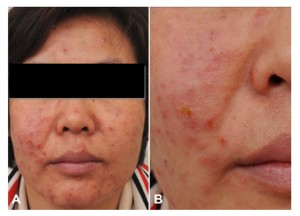 (A and B) Multiple erythematous vesicopustular papules with oozing crusts on the face