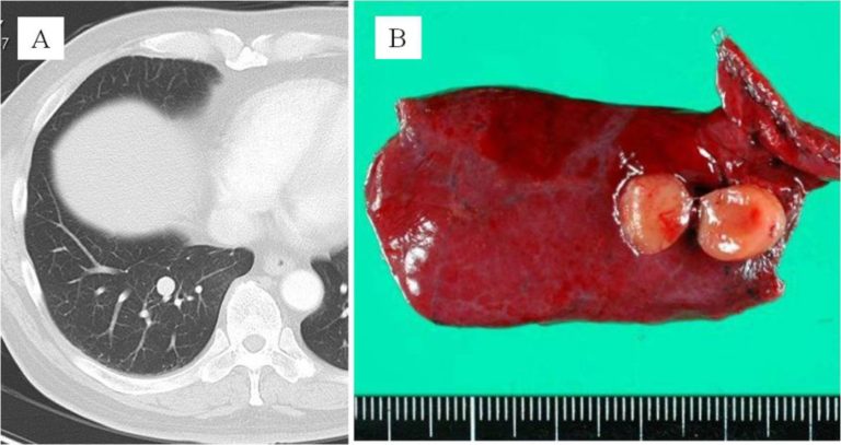 Ibima Publishing Synchronous Bilateral Peripheral Typical Pulmonary Carcinoid Tumors Report 1512