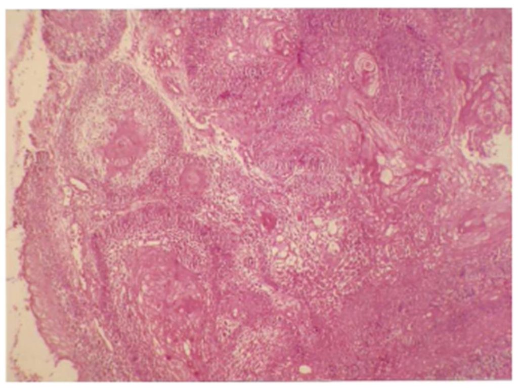 IBIMA Publishing Ameloblastic Carcinoma Of The Mandible: A Rare Case ...