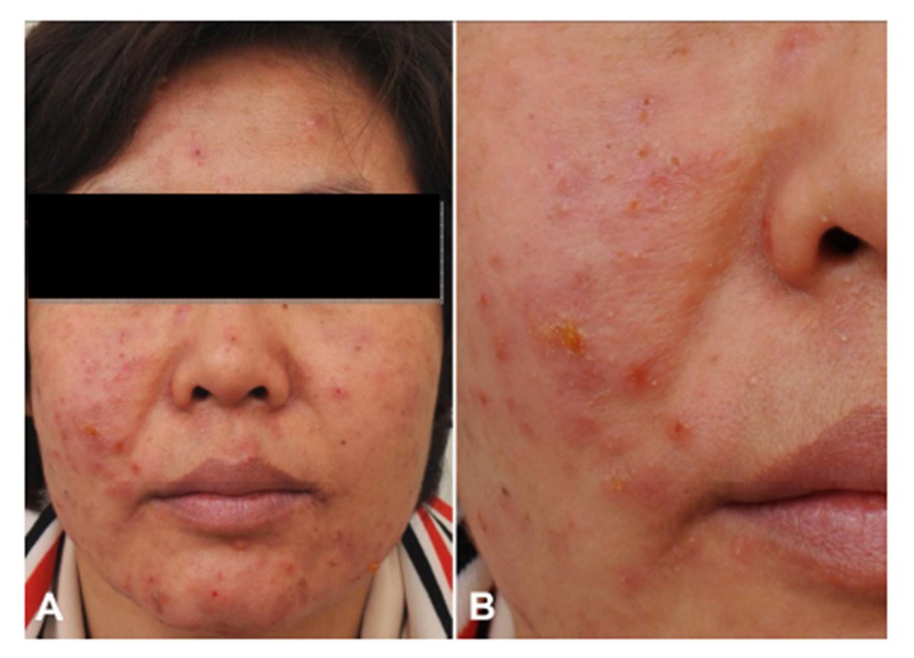 IBIMA Publishing Eosinophilic Pustular Folliculitis In A Patient With ...